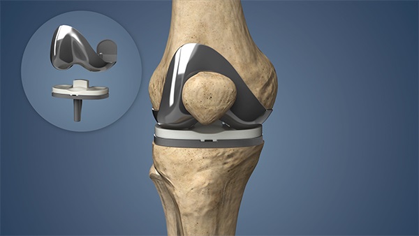 Benefits and Risks of Knee Replacement Surgery